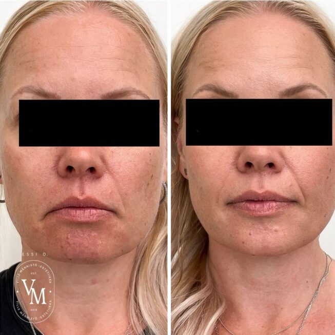 Botox for lifting the corners of the mouth
