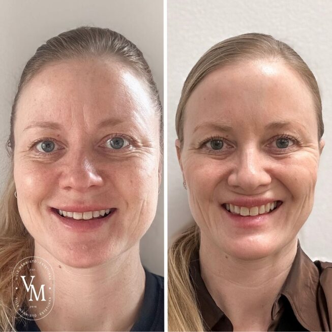 botox-espoo