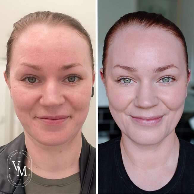 botox-forssa