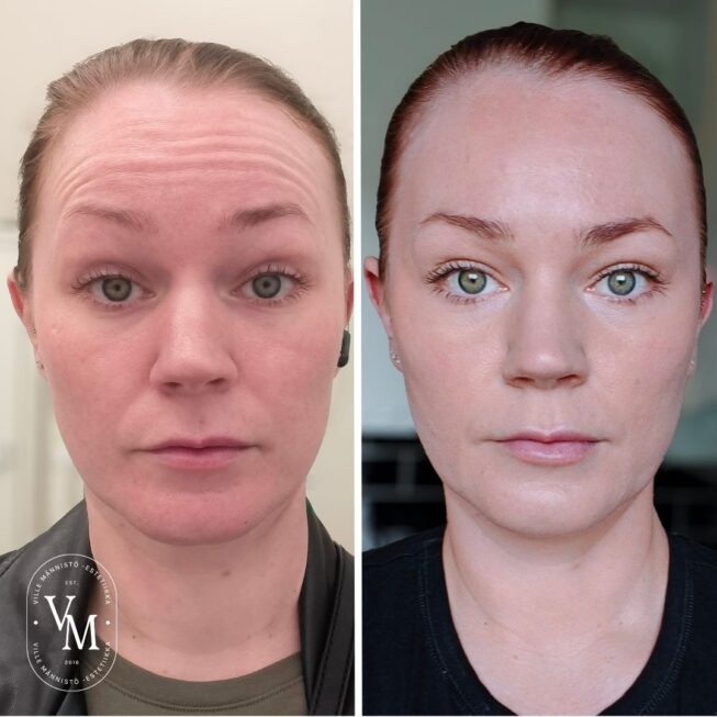 Botox for the Forehead in Espoo