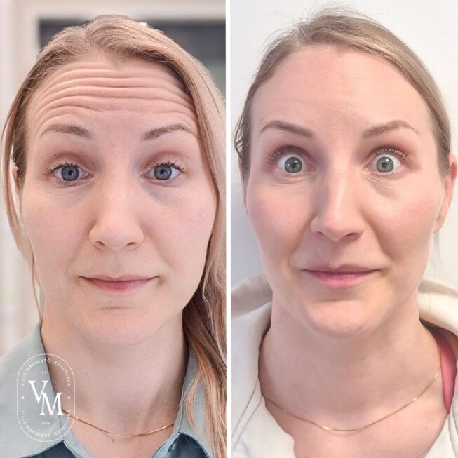 Botox for the forehead: 270 euros