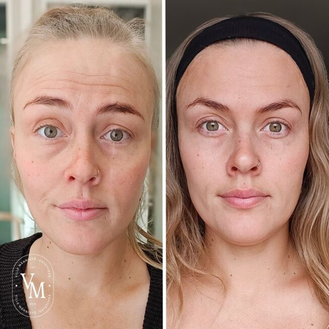 Botox on the Forehead: Experiences