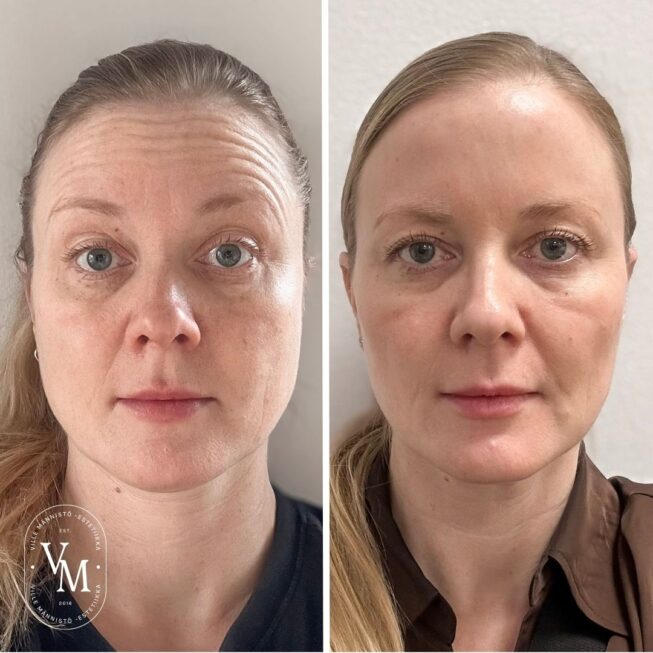 Botox for the Forehead in Tampere