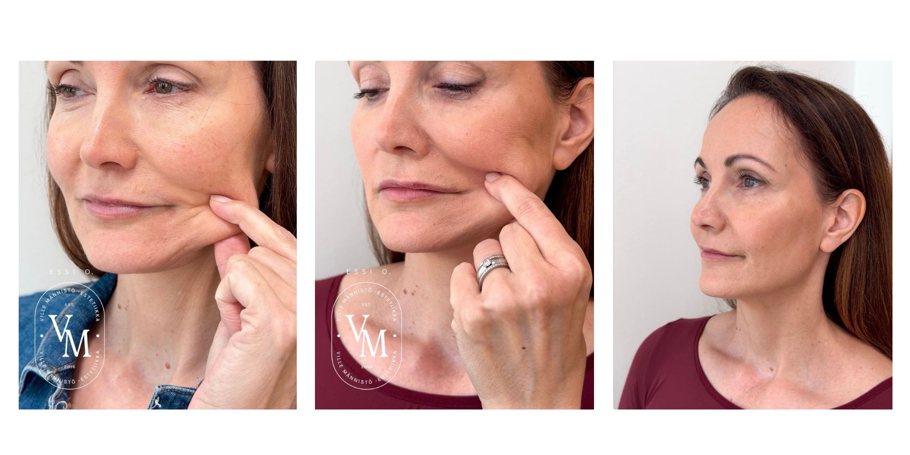 Before and after HarmonyCa® treatment. The firmness of the lower face has improved, and the jawline is more defined.