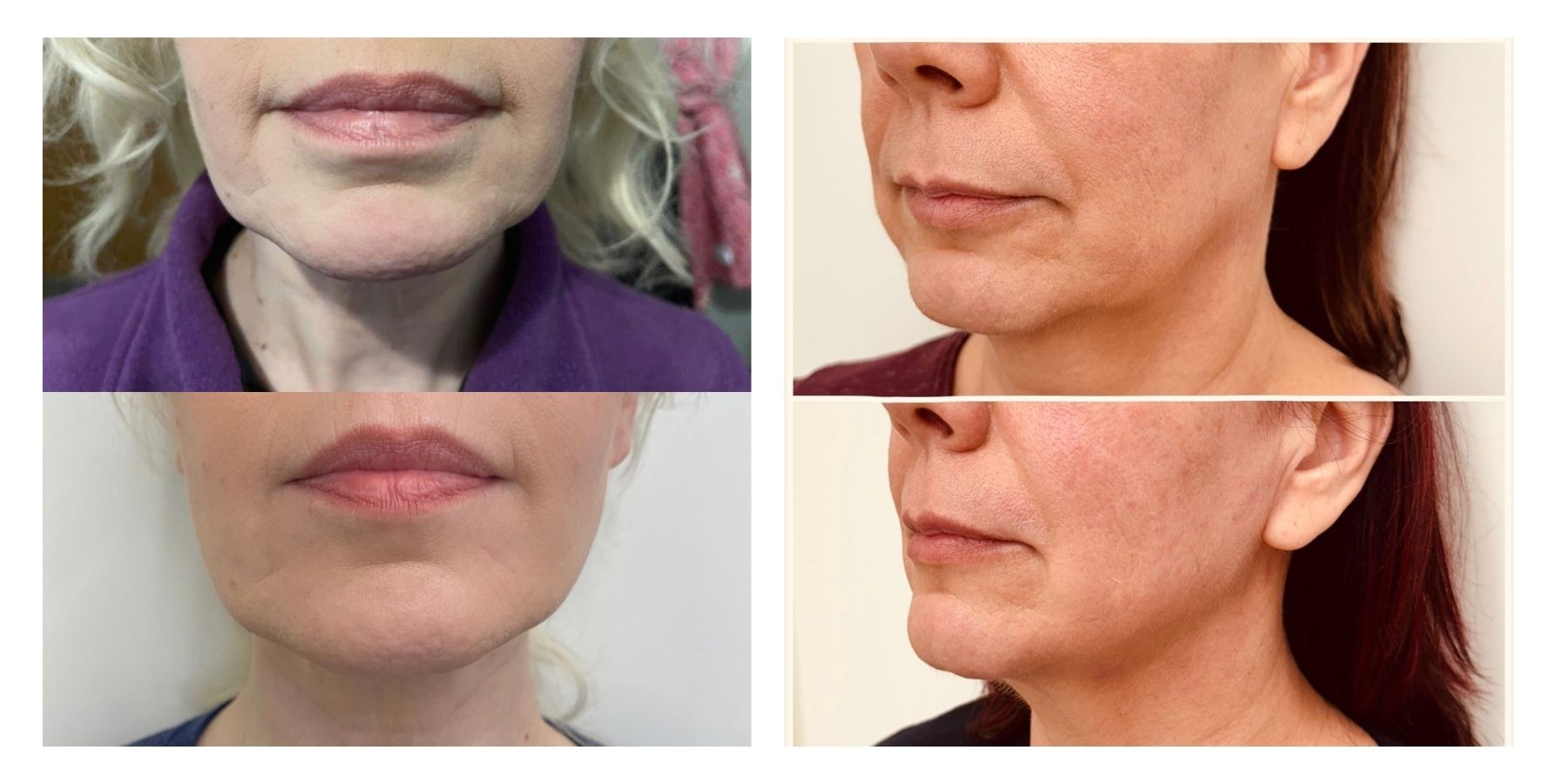 Before and after thread lift treatment. The jawline is more defined, and the sagging tissues in the lower face have been lifted.