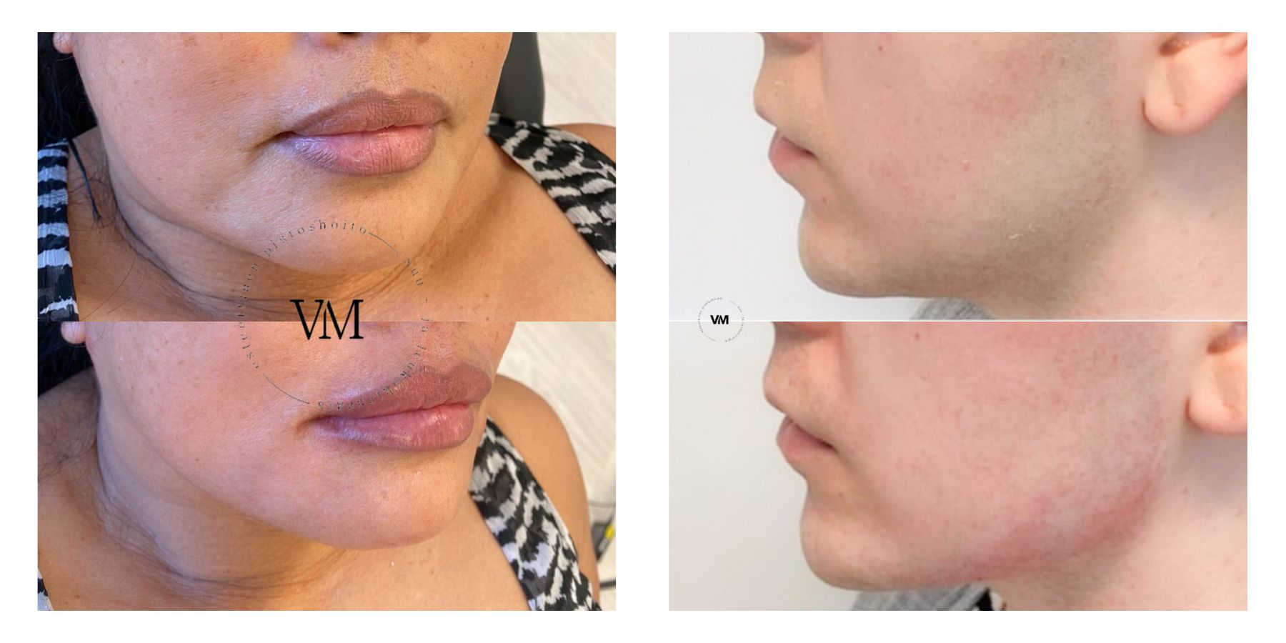 Before and after dermal filler treatment for the jawline. The filler defines the contours of the jawline and supports the structure of the lower face.