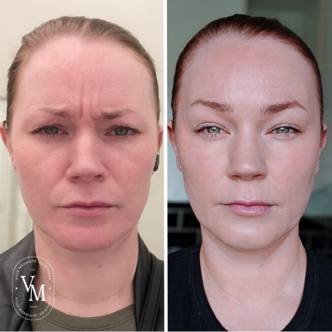 Sibelius Wrinkle - Hyaluronic Acid - Botox