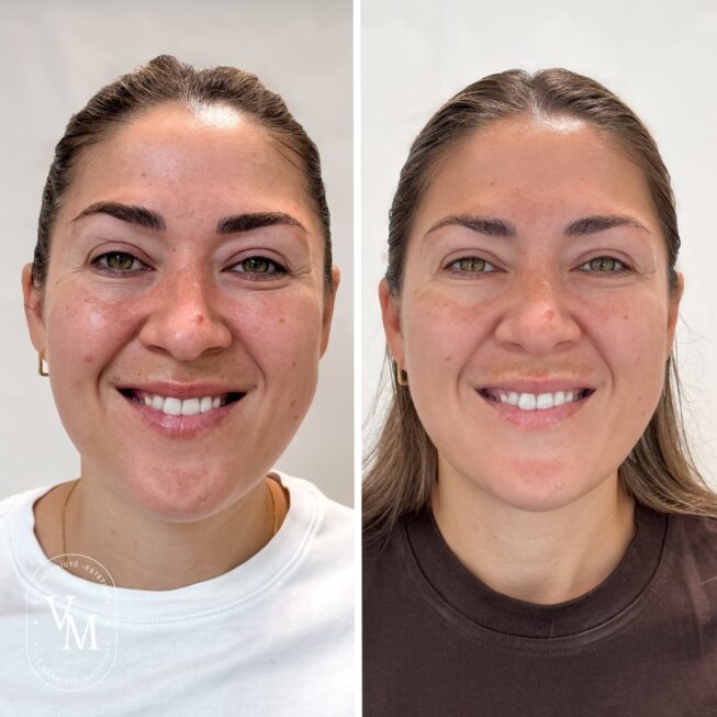 baby Botox (2)