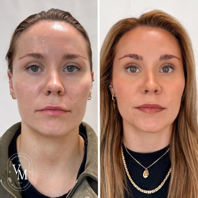 baby Botox (3)