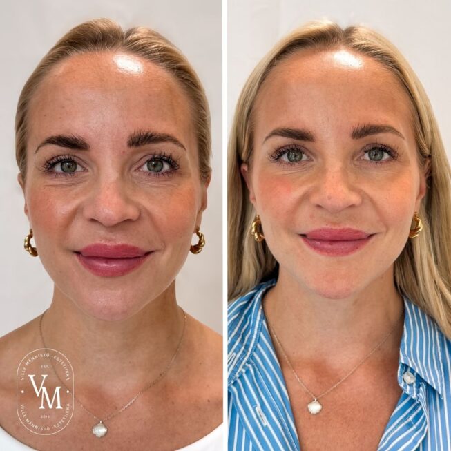 baby Botox (4)