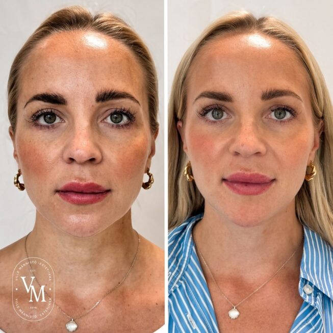 baby Botox (5)