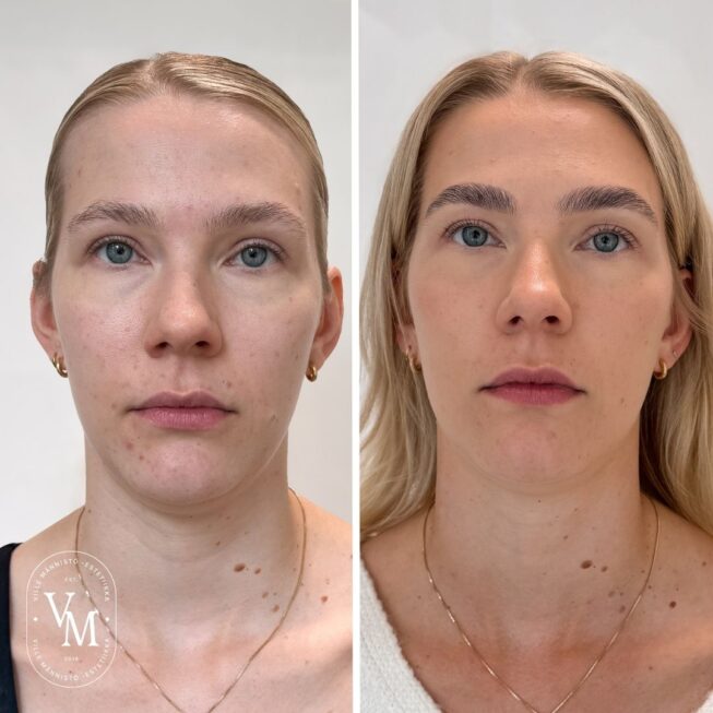 baby Botox (6)