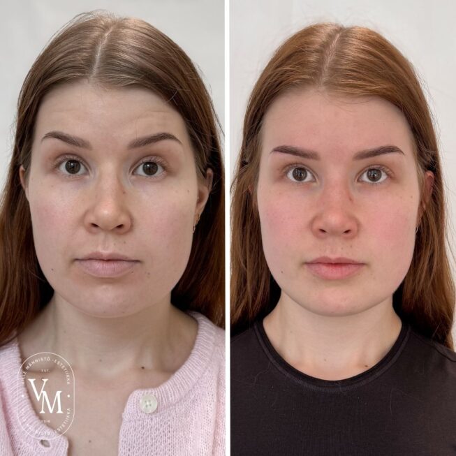 baby Botox