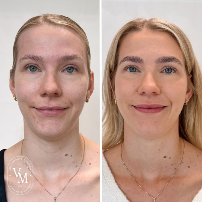 baby Botox (7)
