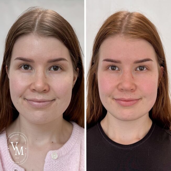 baby-botox-preventive-botulinum-toxin-treatment