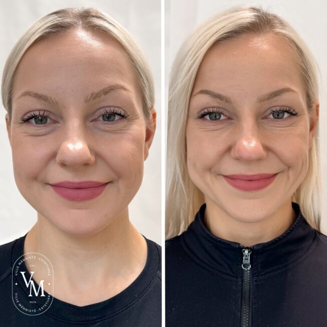 baby-botox-helsinki