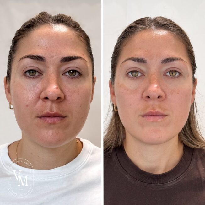 Botox: Before and After