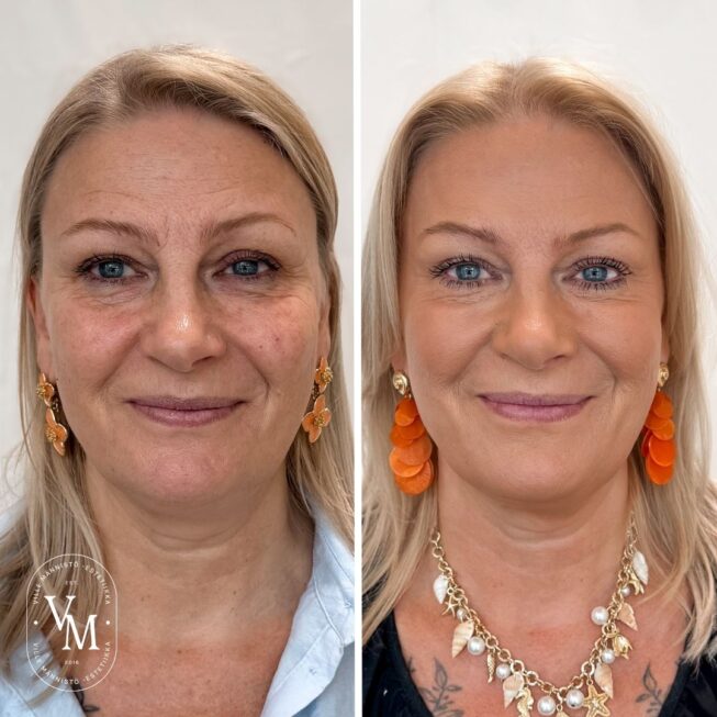 botox-espoo