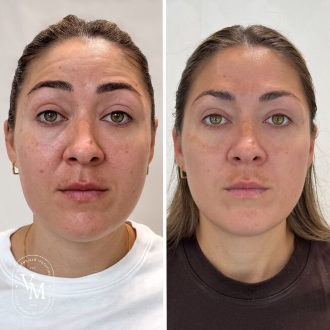 botox-espoo-botox-vantaa (2)