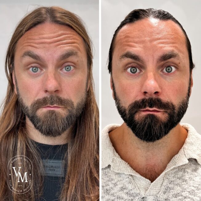 botox-espoo-botox-vantaa