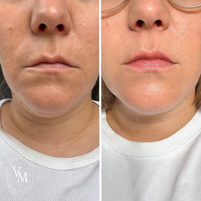 Botox for a square jaw