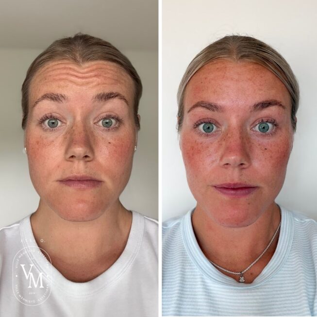 Botox-on-the-Forehead-Essi-Ojala (3)
