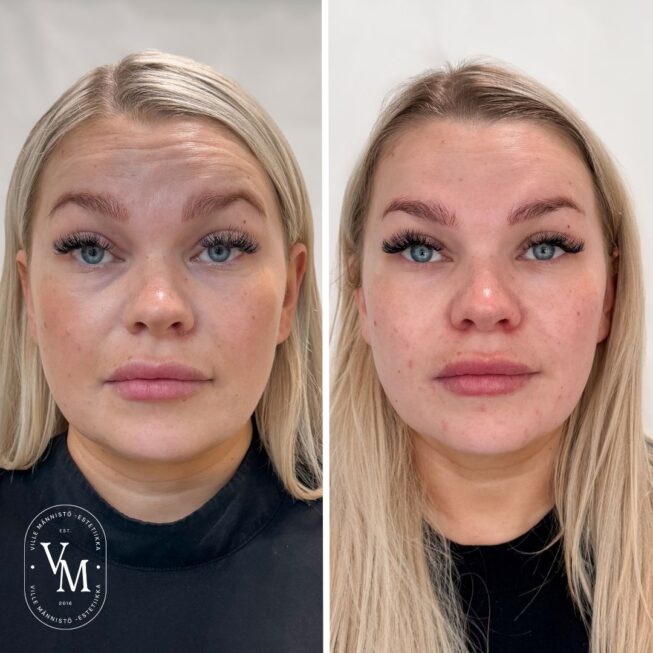 Botox for Forehead Wrinkles