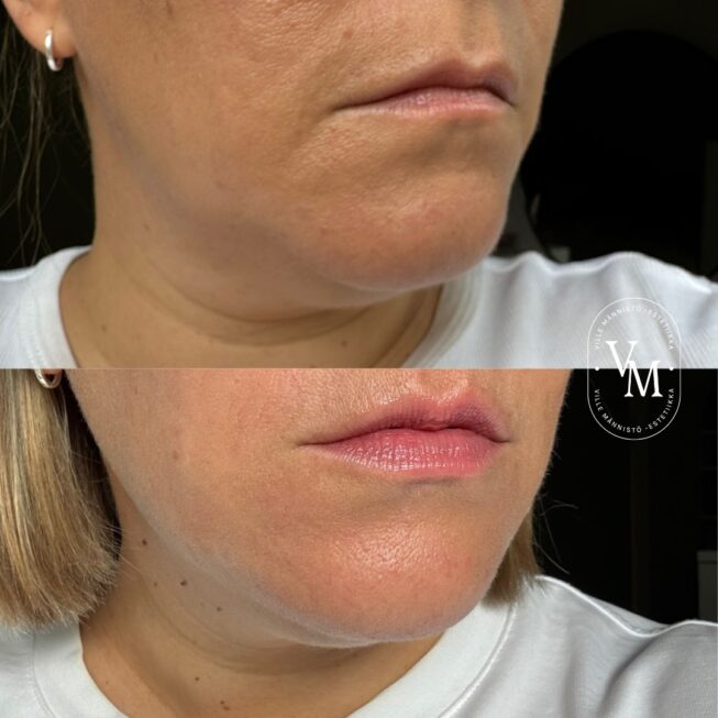 Botox Lip Corner Lifts: Before and After Experiences