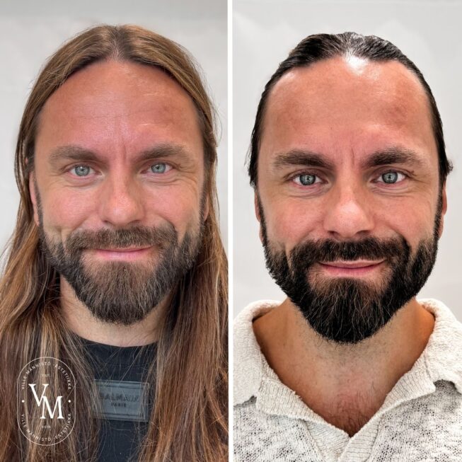 Brotox—Botox for Men