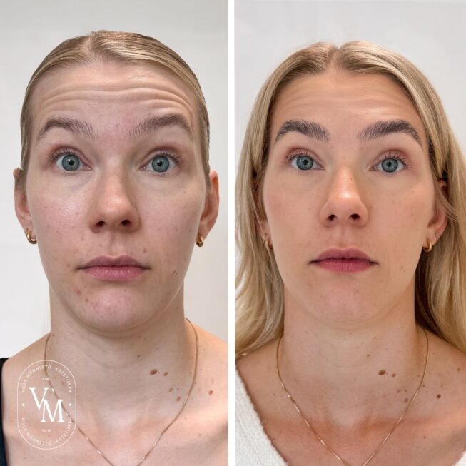 natural-botox-for-the-forehead