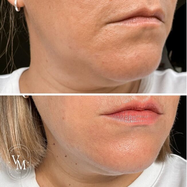 Nefertiti Lift, Botox, Corners of the Mouth (1)