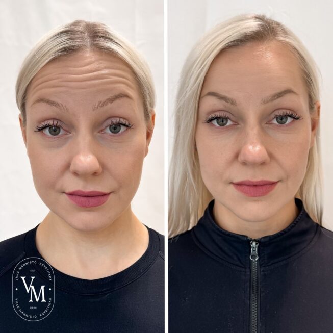 Botox for Forehead Wrinkles (2)