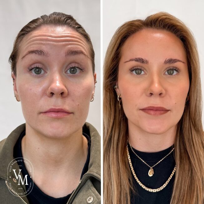 Botox for Forehead Wrinkles