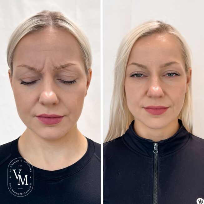Sibelius wrinkle Botox (2)