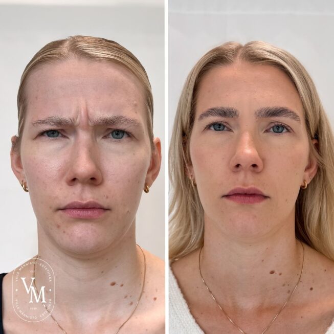 Sibelius Wrinkle Botox (3)