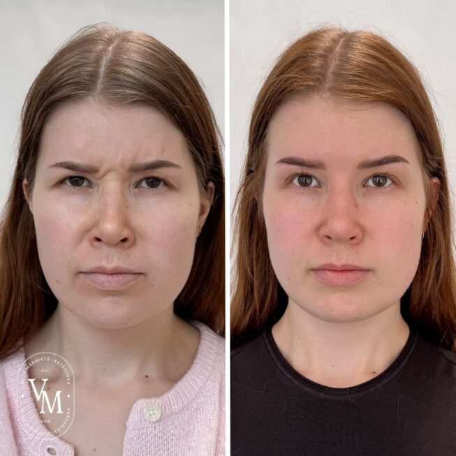 Sibelius wrinkle Botox