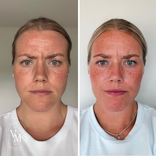 Sibelius Wrinkle-Botox-Essi-Ojala (3)
