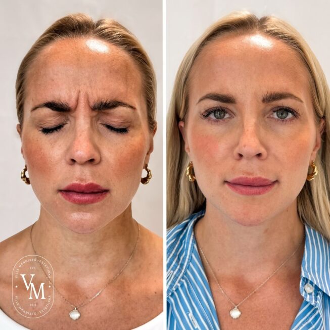Botox-frownlines-price: 270 euros