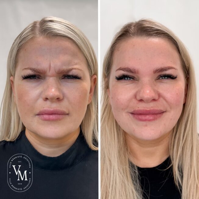 Sibelius Wrinkle-Botox-Tampere (3)